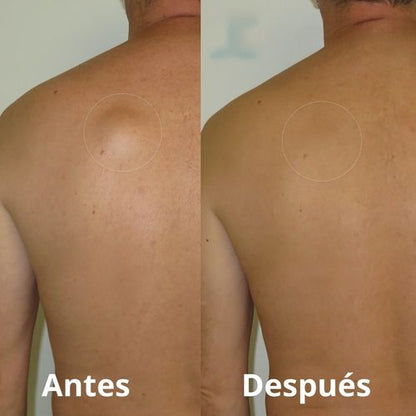 LipoClear™ nuevo Tratamiento eliminador de LIPOMAS