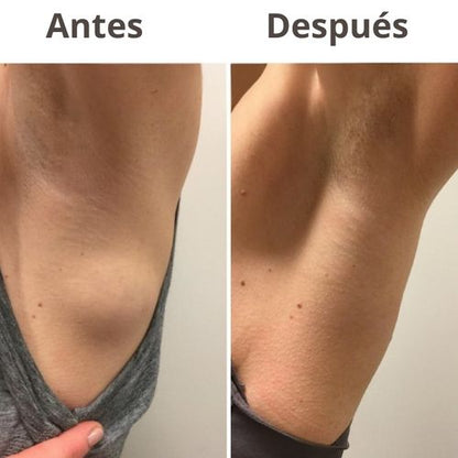 LipoClear™ nuevo Tratamiento eliminador de LIPOMAS
