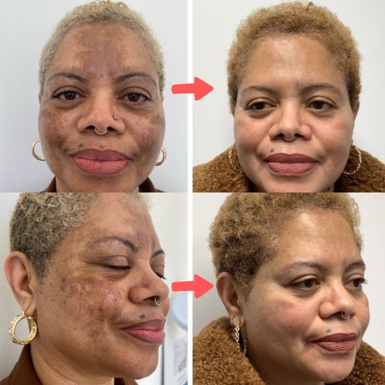Sérum aclarador Bio-Exfoliante Inteligente🧬+