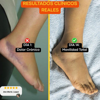 Fascitol™ - Tratamiento Clínico Eliminador de Fascitis Plantar