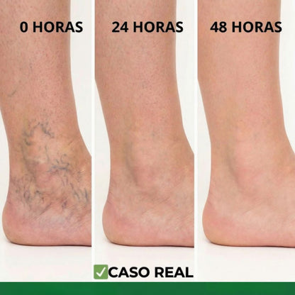 GuanJing® - Tratamiento Natural Eliminador de Varices