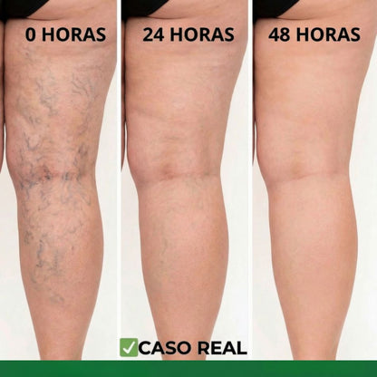 GuanJing® - Tratamiento Natural Eliminador de Varices