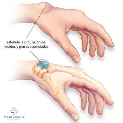 LipoClear™ nuevo Tratamiento eliminador de LIPOMAS