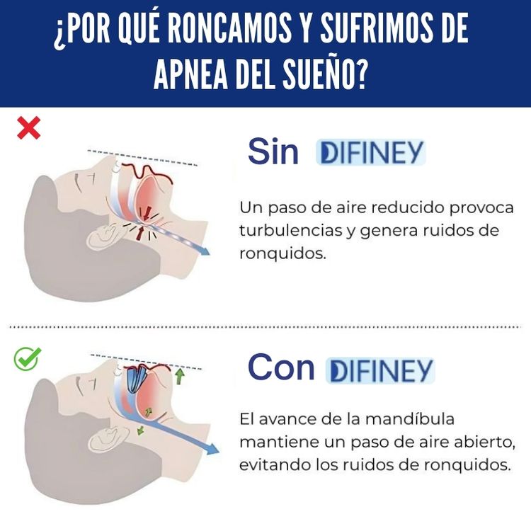 DIFINEY® Antirronquidos Alineador Mandibular 1