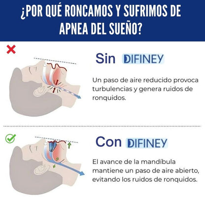 DIFINEY® Antirronquidos Alineador Mandibular 1